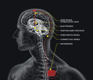 Illustration for article titled A Brain Implant That Treats Severe Eating Disorders